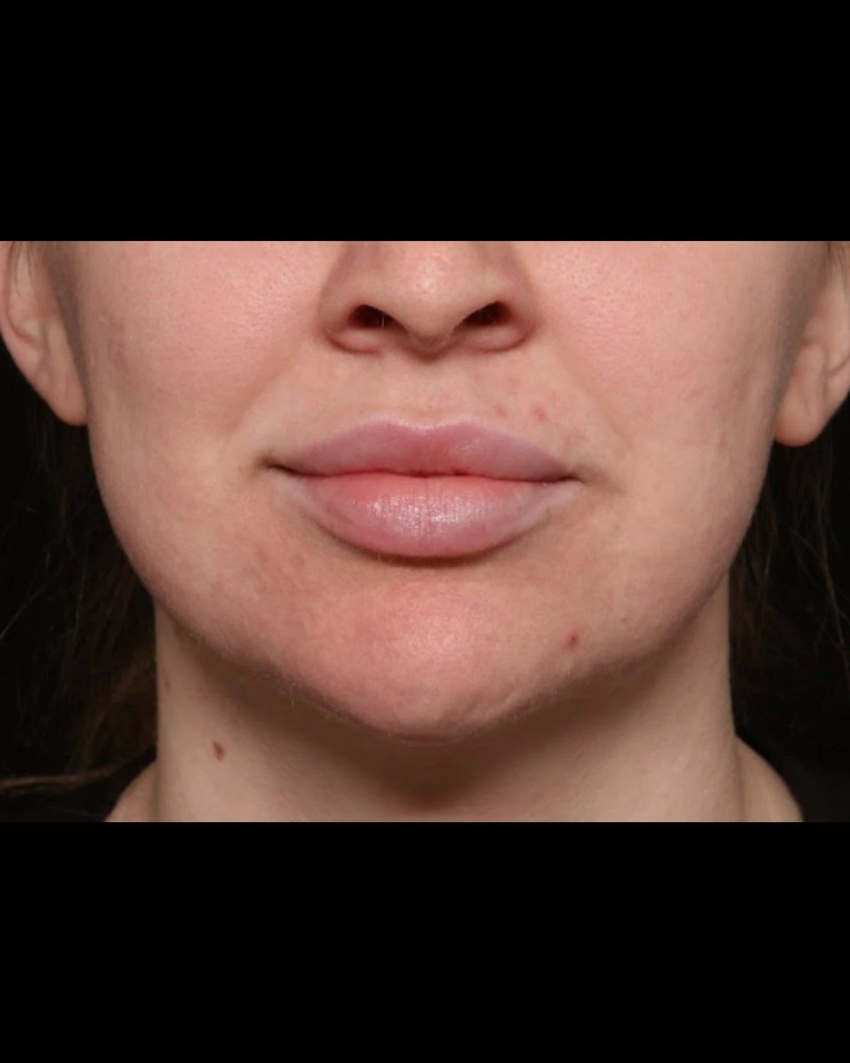 Front Liposuction (5L) (Same As Lipo360) before
