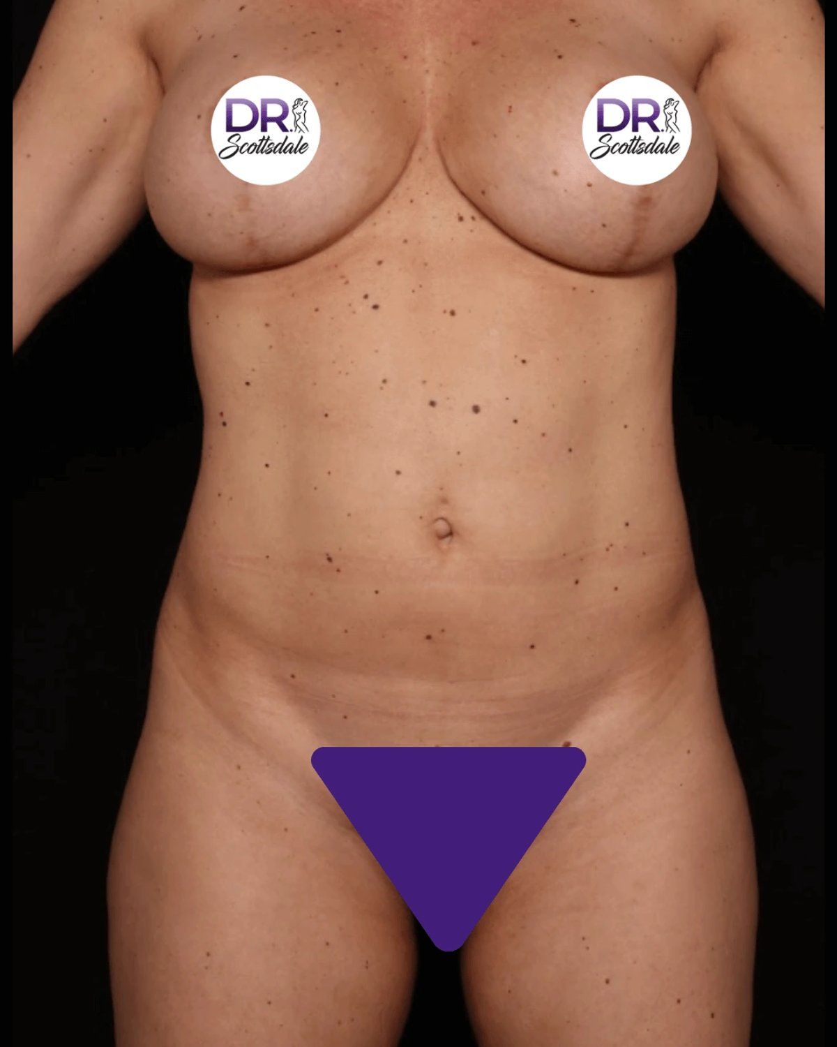 Vaser Lipo 360 (5L Max) before