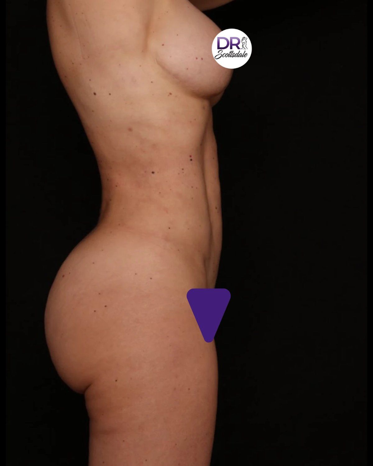 Vaser Lipo 360 (5L Max), Right Profile view, after