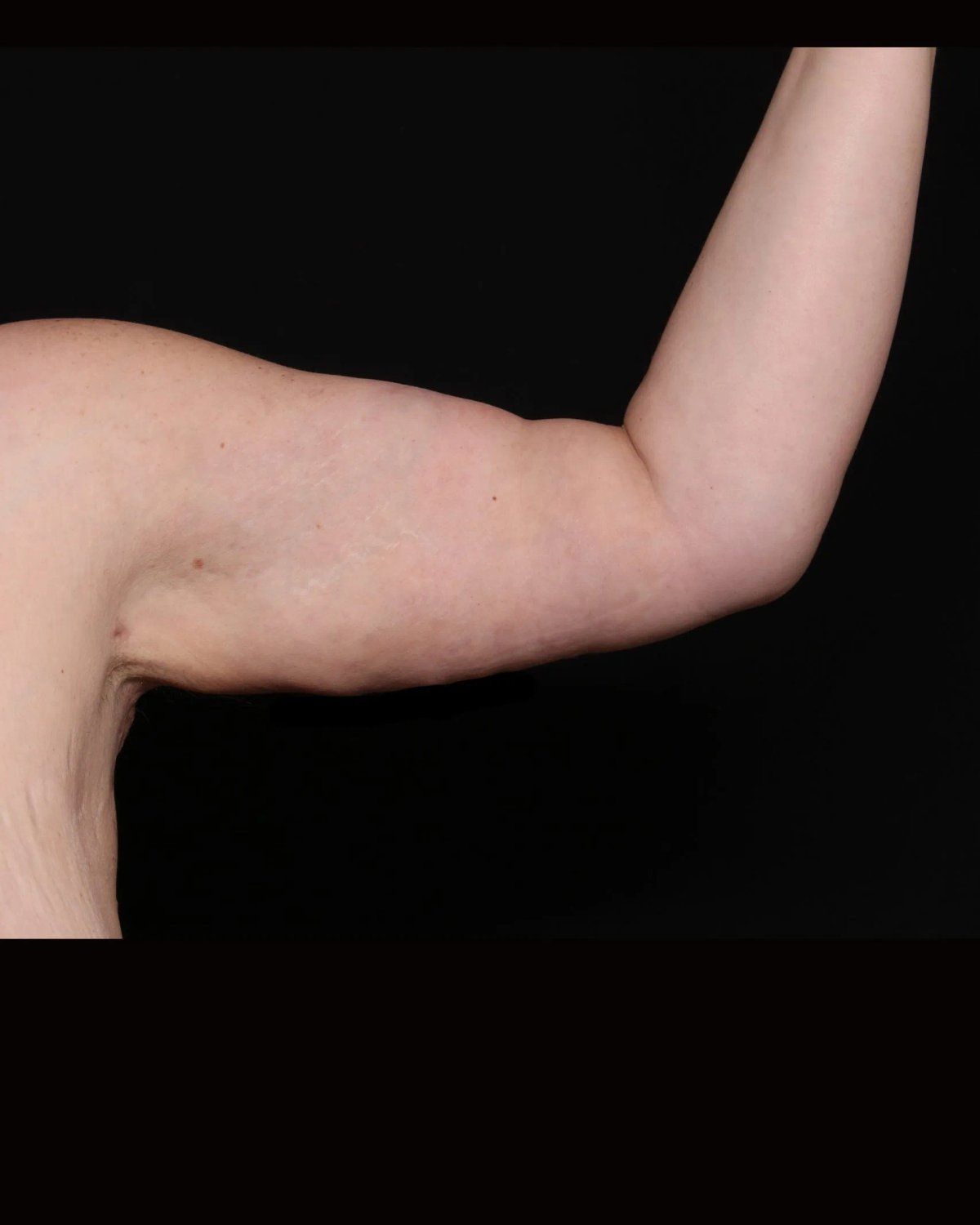 Arm Lift after