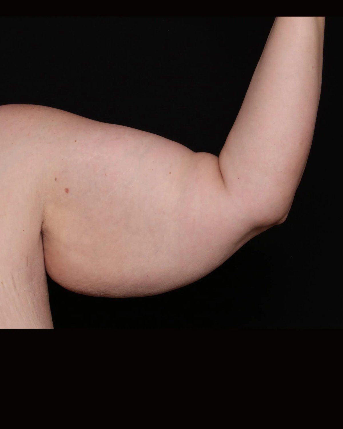 Arm Lift before