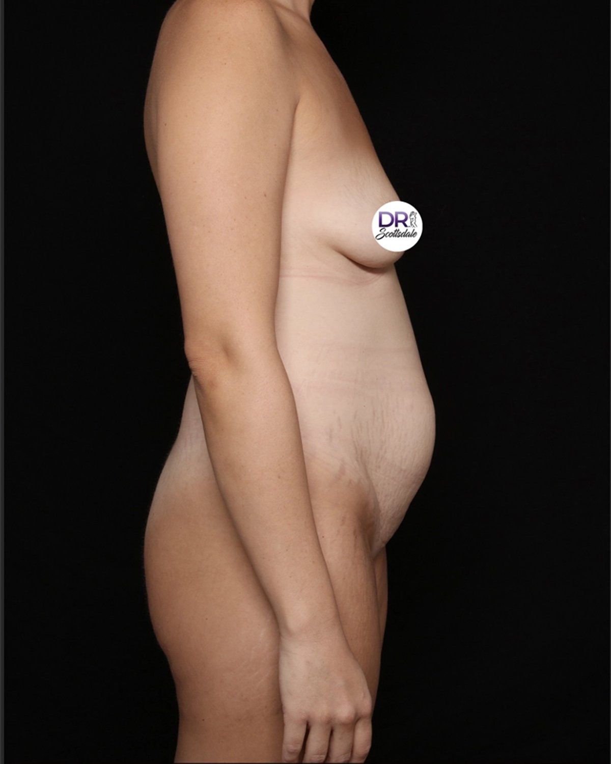 Breast Augmentation with Implants before
