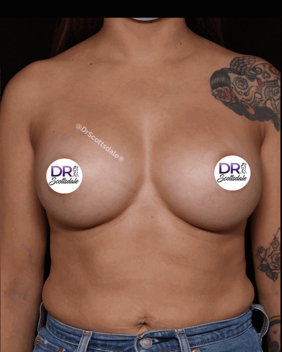 Breast Augmentation with Implants after