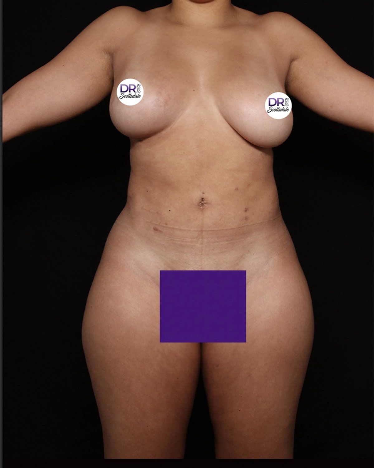 Front Liposuction (5L) (Same As Lipo360) after