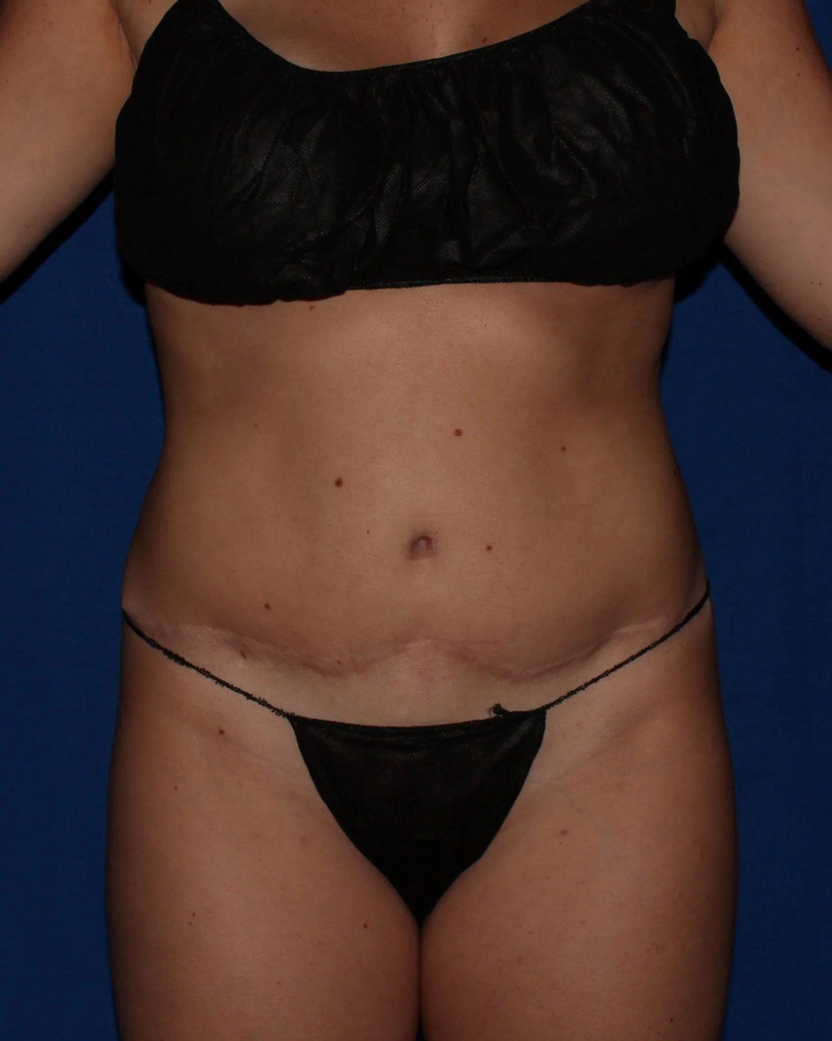 Implant Exchange Complete (Silicone Implants) before