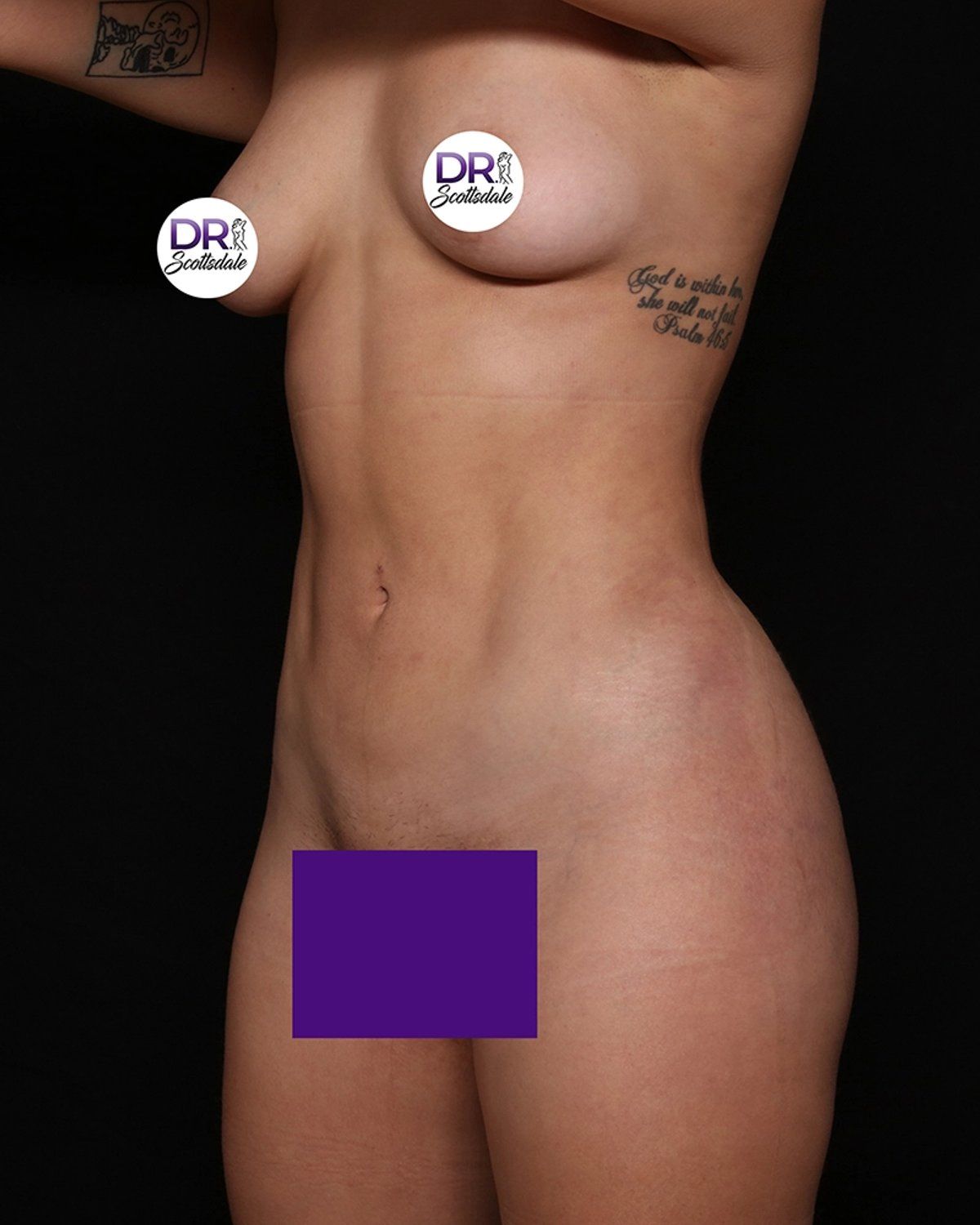 Vaser Lipo 360 (5L Max) after