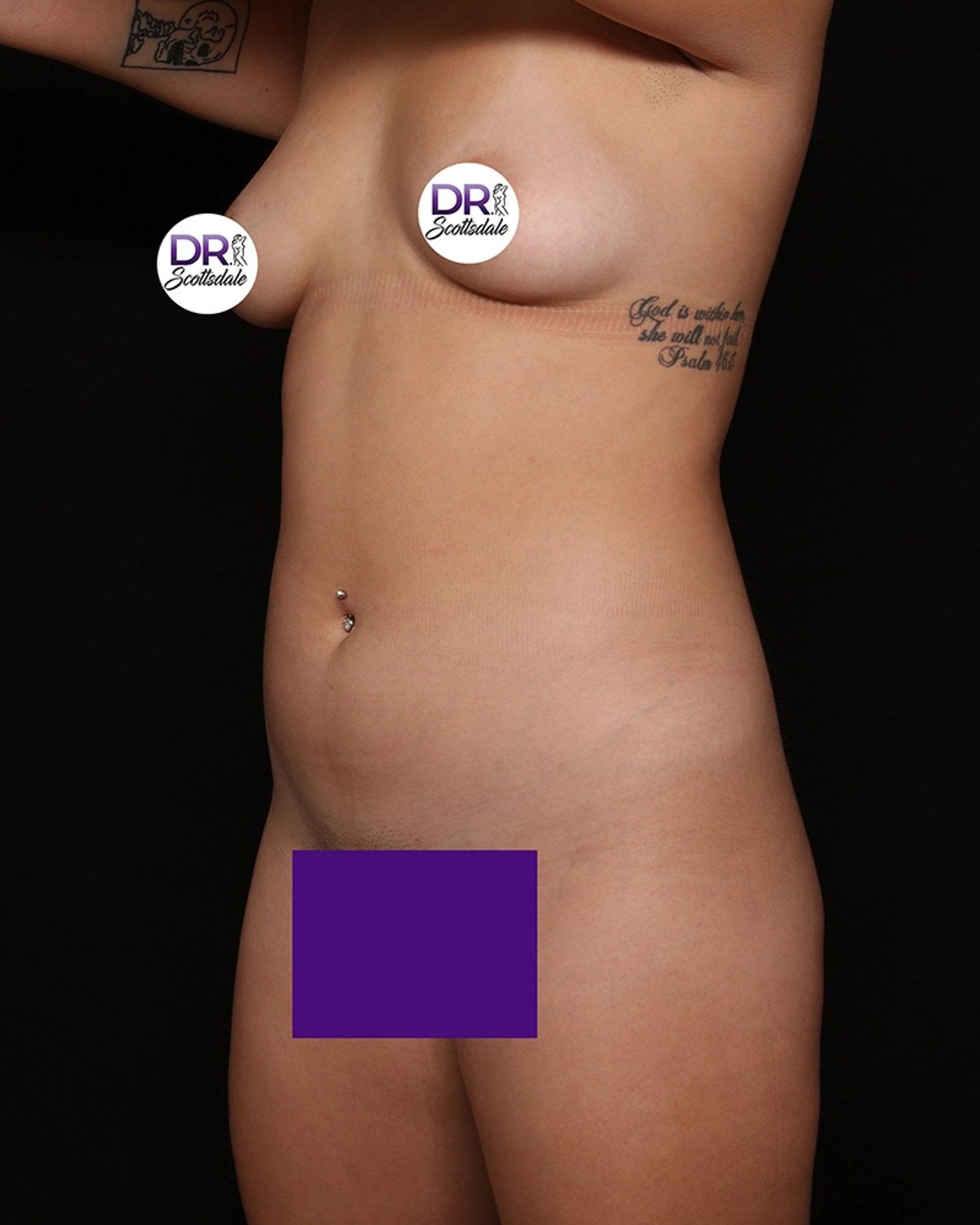 Vaser Lipo 360 (5L Max) before