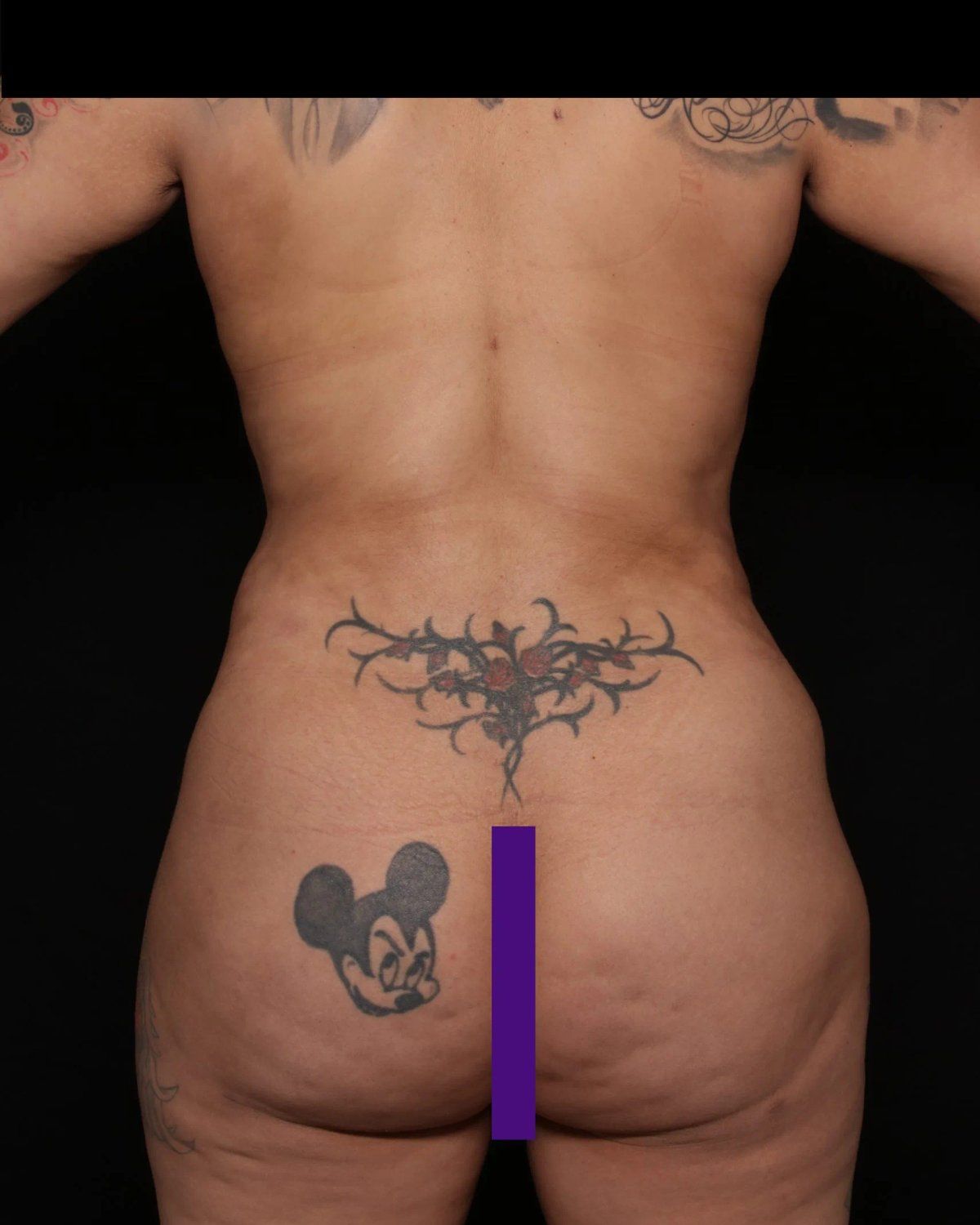 Front Liposuction (5L) (Same As Lipo360), Back view, after