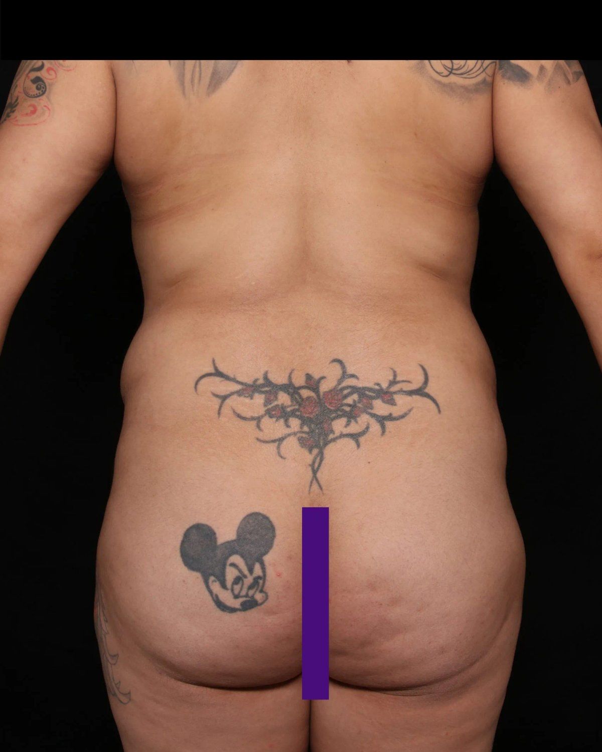 Front Liposuction (5L) (Same As Lipo360), Back view, before
